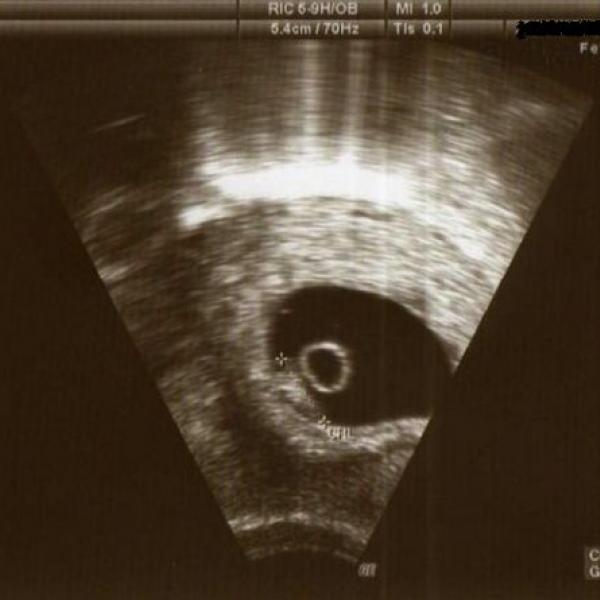První ultrazvuk