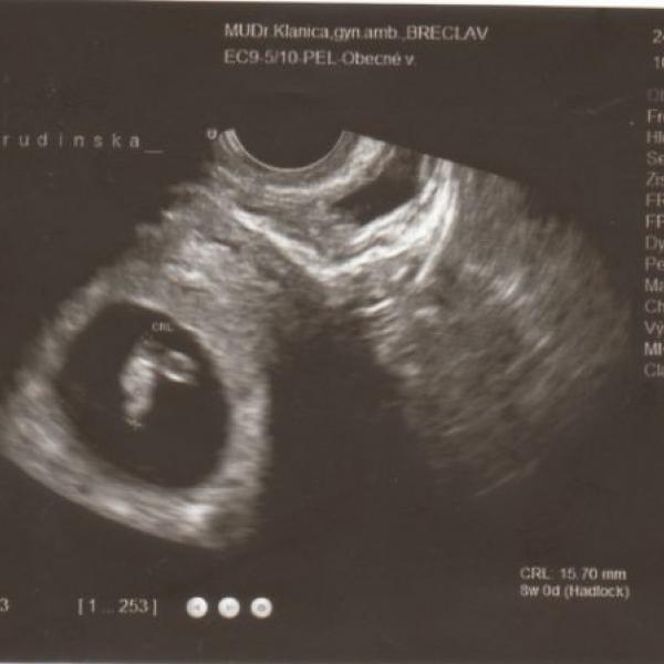foto ultrazvuk 9tt