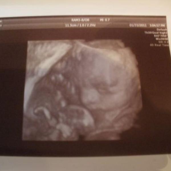 3 D ultrazvuk naší krásné ROZÁRKY!!! ♥♥♥♥♥♥♥♥♥♥♥♥♥♥♥♥♥♥♥♥