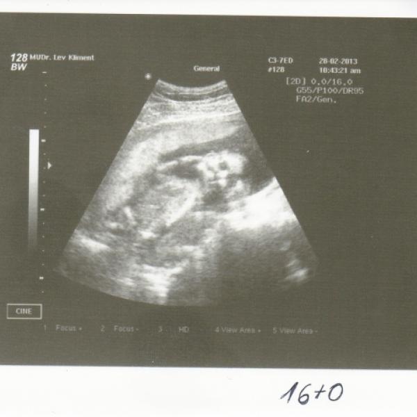 Obrázek ultrazvuku a pohlaví (15+1)