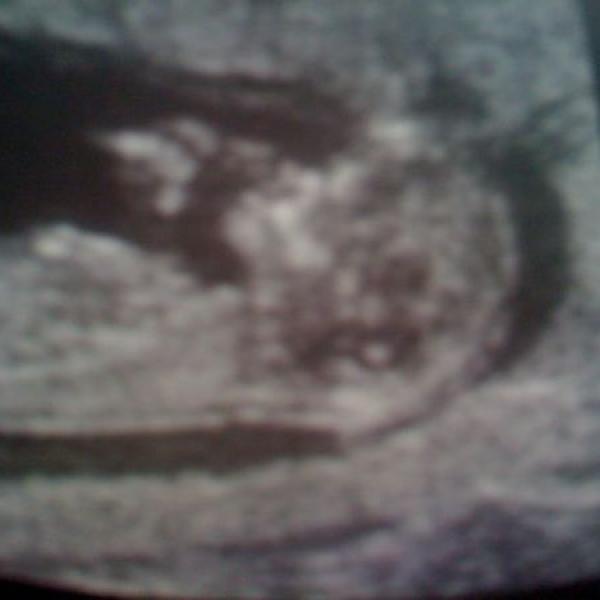 fotka z ultrazvuku