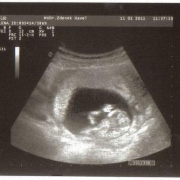 foto z ultrazvuku