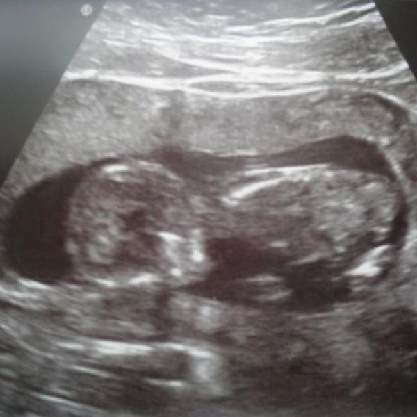 prvotrimestrální screening :-)