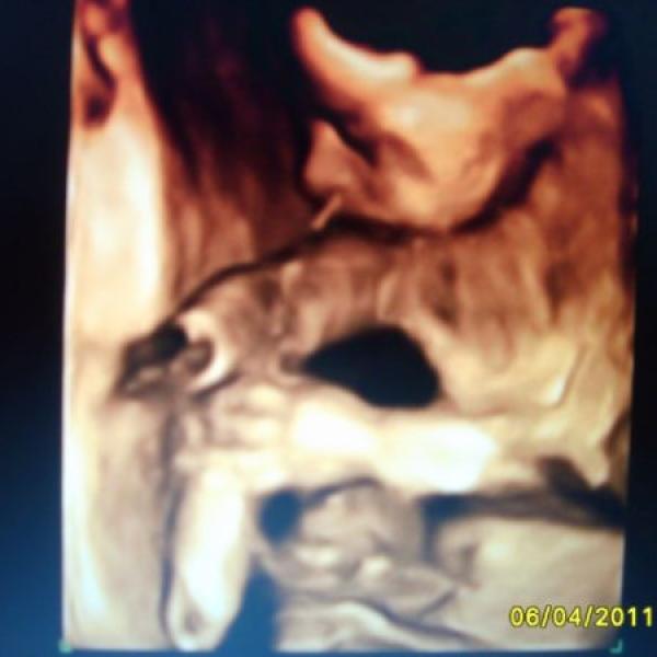 3D ultrazvuk:)