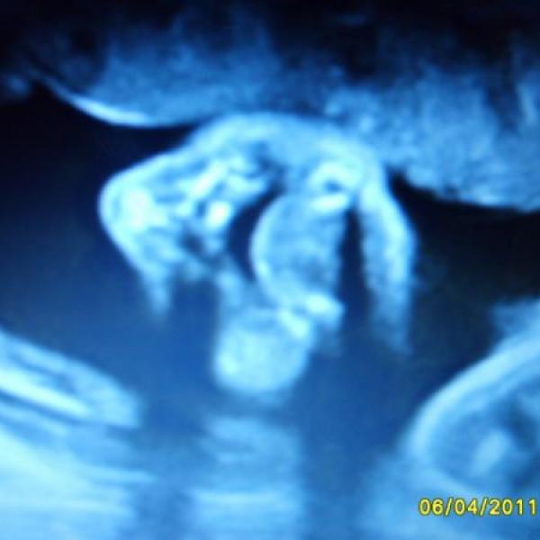 3D ultrazvuk:)