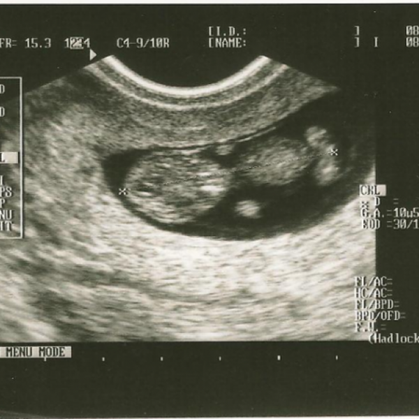 Dnešní ultrazvuk 10+4 aneb už mám těhotenskou průkazku :)