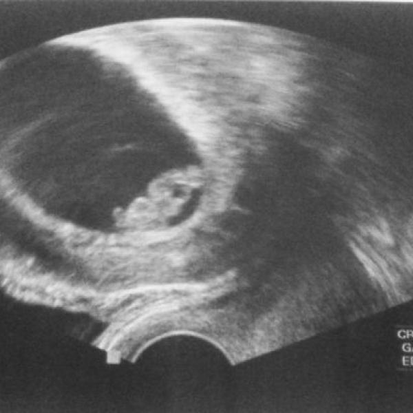 Těhulka po první ovulaci za 13 let.