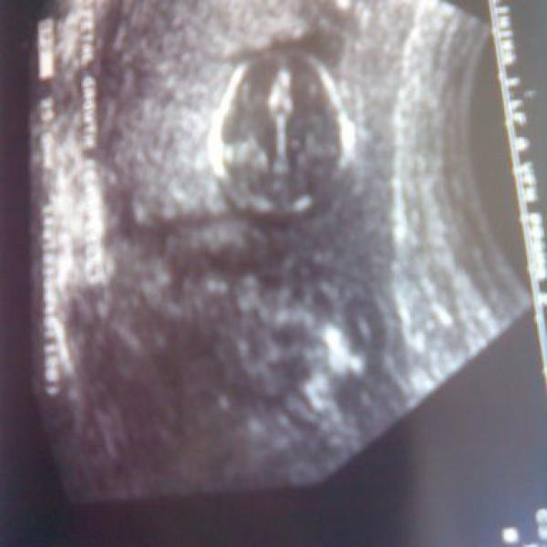 Kontrolní ultrazvuk
