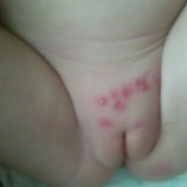 Prosím myslíte, že to jsou opruzeniny?? Máme IMPETIGO :-((