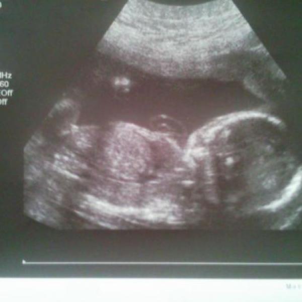 kacenka ma koule...aneb velky ultrazvuk 22tt