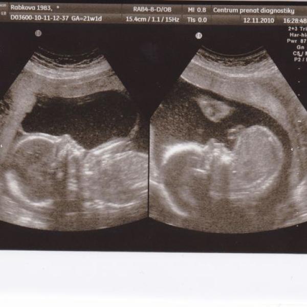 Dvojčátka jsou v pořádku :-) na Moje těhotenství.cz Dvojčátka jsou v pořádku :-)