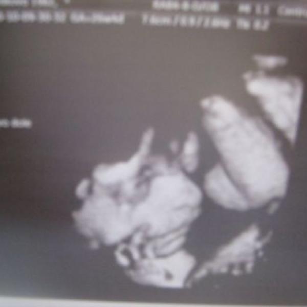 3d ultrazvuk a bříško