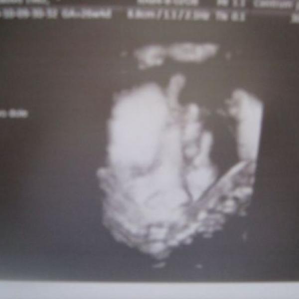 3d ultrazvuk a bříško