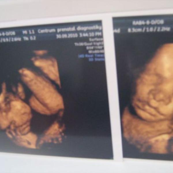 3d ultrazvuk a bříško