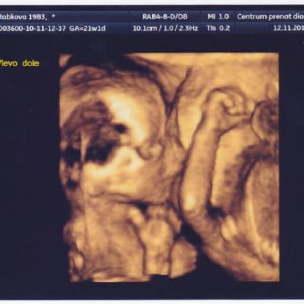 Dvojčátka jsou v pořádku :-) na Moje těhotenství.cz Dvojčátka jsou v pořádku :-)