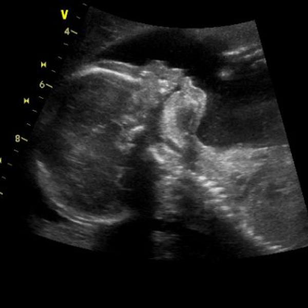 Ultrazvuk ve 20. týdnu