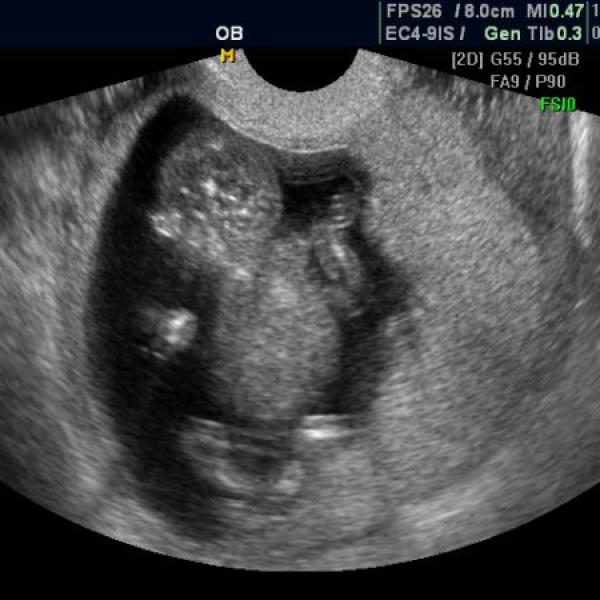 dnešní NT screening