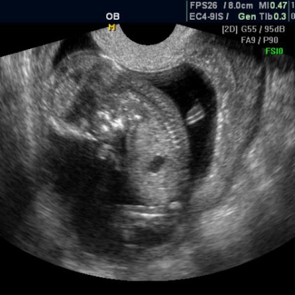 dnešní NT screening