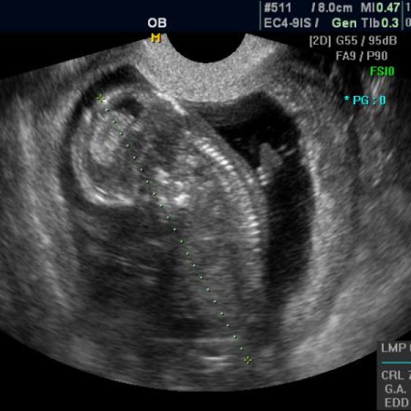 dnešní NT screening