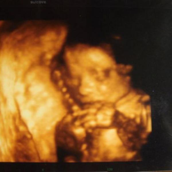 3D - 4D ultrazvuk 24 týden na Moje těhotenství.cz 3D - 4D ultrazvuk 24 týden