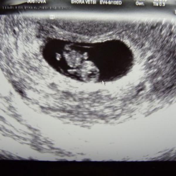 Náš první ultrazvuk 