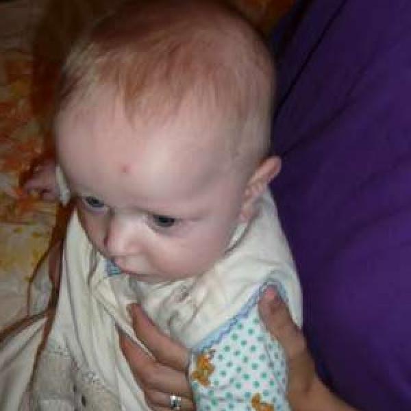 pupínky u 5timěsíčního kojence