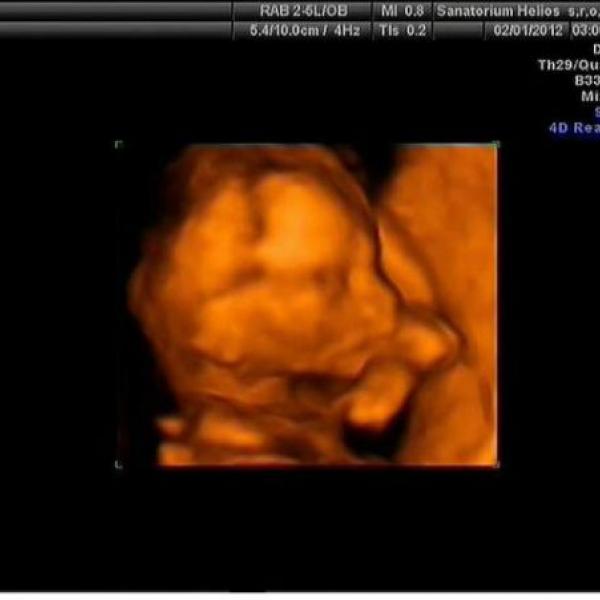 dnešní 3D ultrazvuk :)
