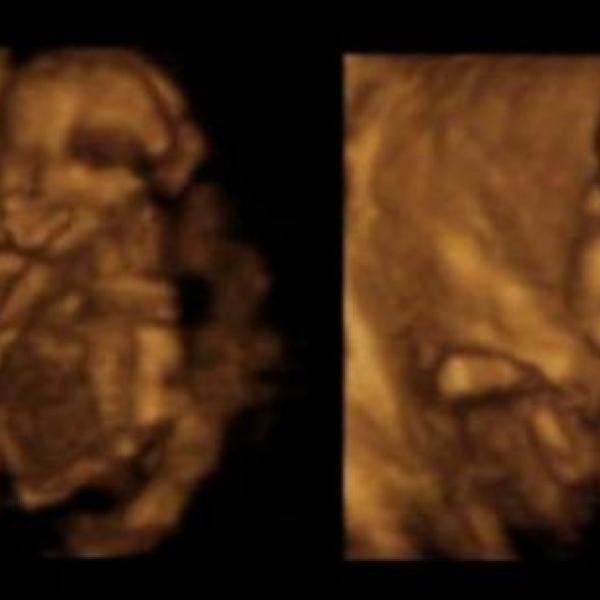 4D ultrazvuk v 16+6