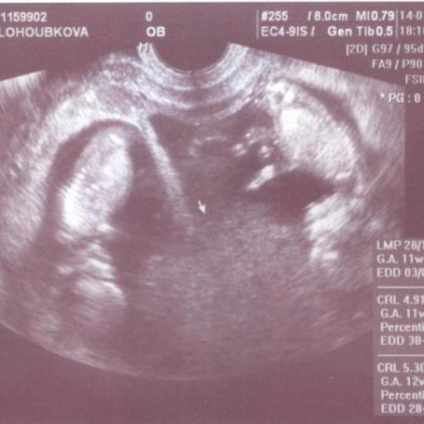 Čekáme dvojčátka