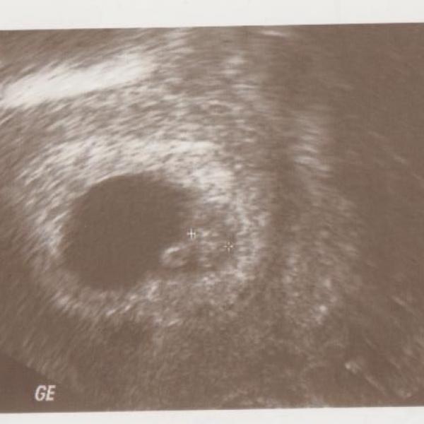 Zahajuji si blog &quot;Moje 2-hé těhotenství&quot; aneb sem těhotnááááááááááá....