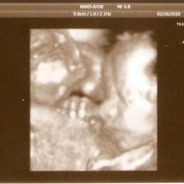 3D ultrazvuk na Moje těhotenství.cz 3D ultrazvuk