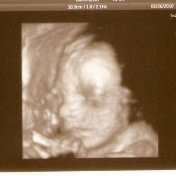 3D ultrazvuk na Moje těhotenství.cz 3D ultrazvuk