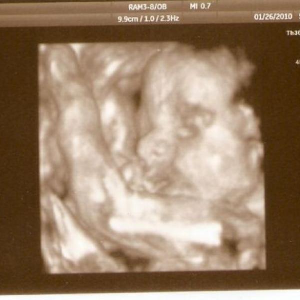 3D ultrazvuk na Moje těhotenství.cz 3D ultrazvuk