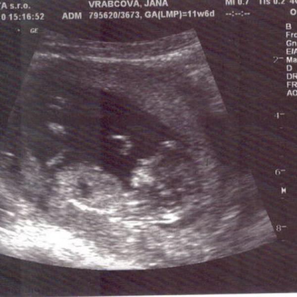 Dobré zprávy, screening a fotečka :) na Moje těhotenství.cz Dobré zprávy, screening a fotečka :)