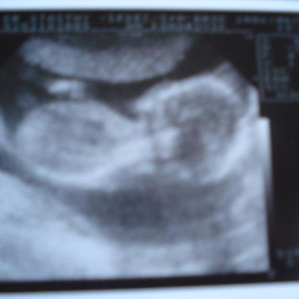 20TT-velký UTZ + foto bříška :)