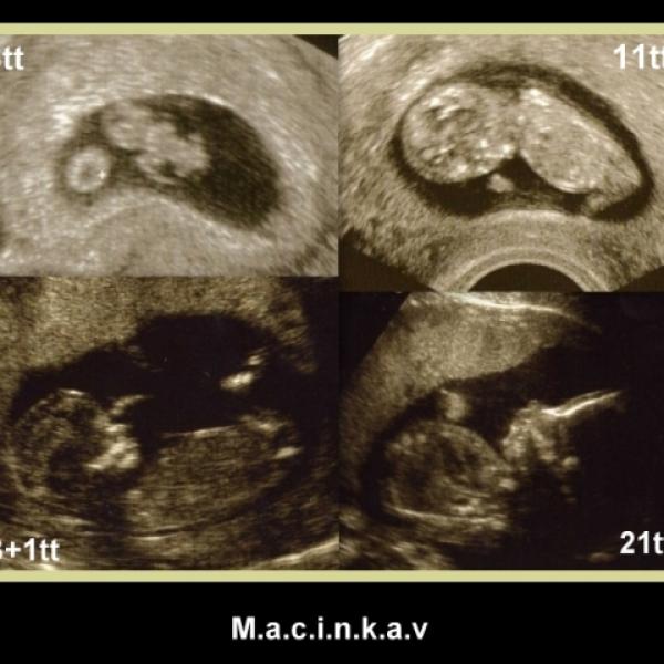 ultrazvuk prosincových miminek 2012