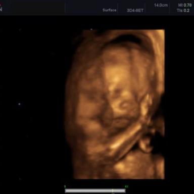 3D ultrazvuk!