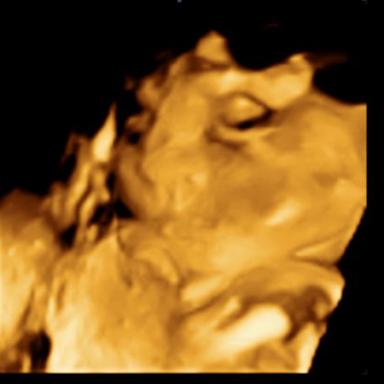 4D ultrazvuk