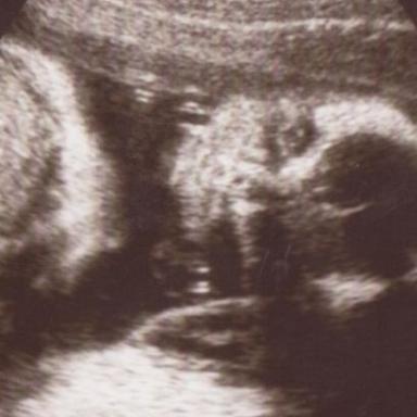 24. tt - první pohled do tvé krásné tvářičky a oGTT