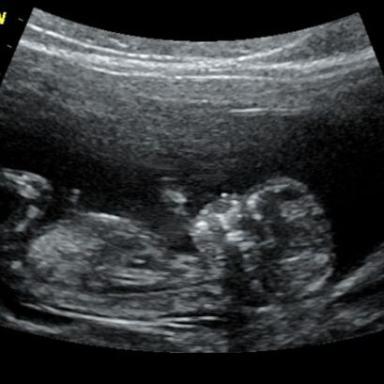 13tt a nt screening absolutně v pořádku, máme zdravý miminko a já byla úplně naměkko :)